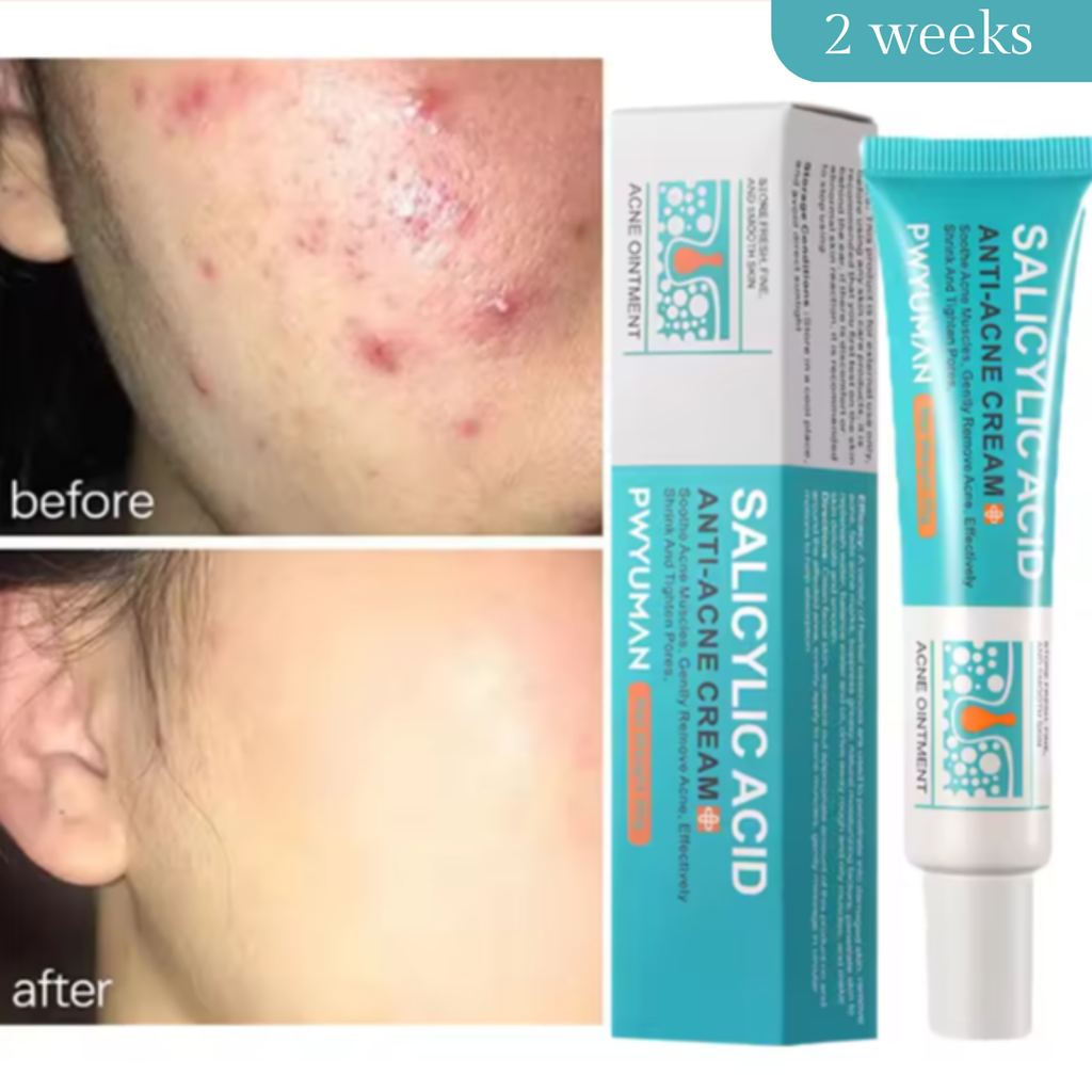 Crema para eliminar el acné con ácido salicílico