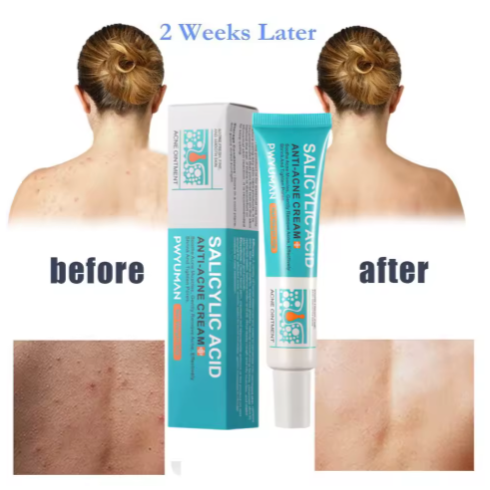 Crema para eliminar el acné con ácido salicílico