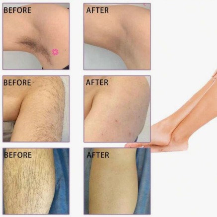 Depiladora eléctrica portátil en forma de lápiz labial